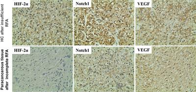 HIF-2α regulates proliferation, invasion, and metastasis of hepatocellular carcinoma cells via VEGF/Notch1 signaling axis after insufficient radiofrequency ablation